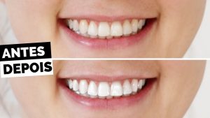 10 maneiras de clarear os dentes em casa naturalmente
